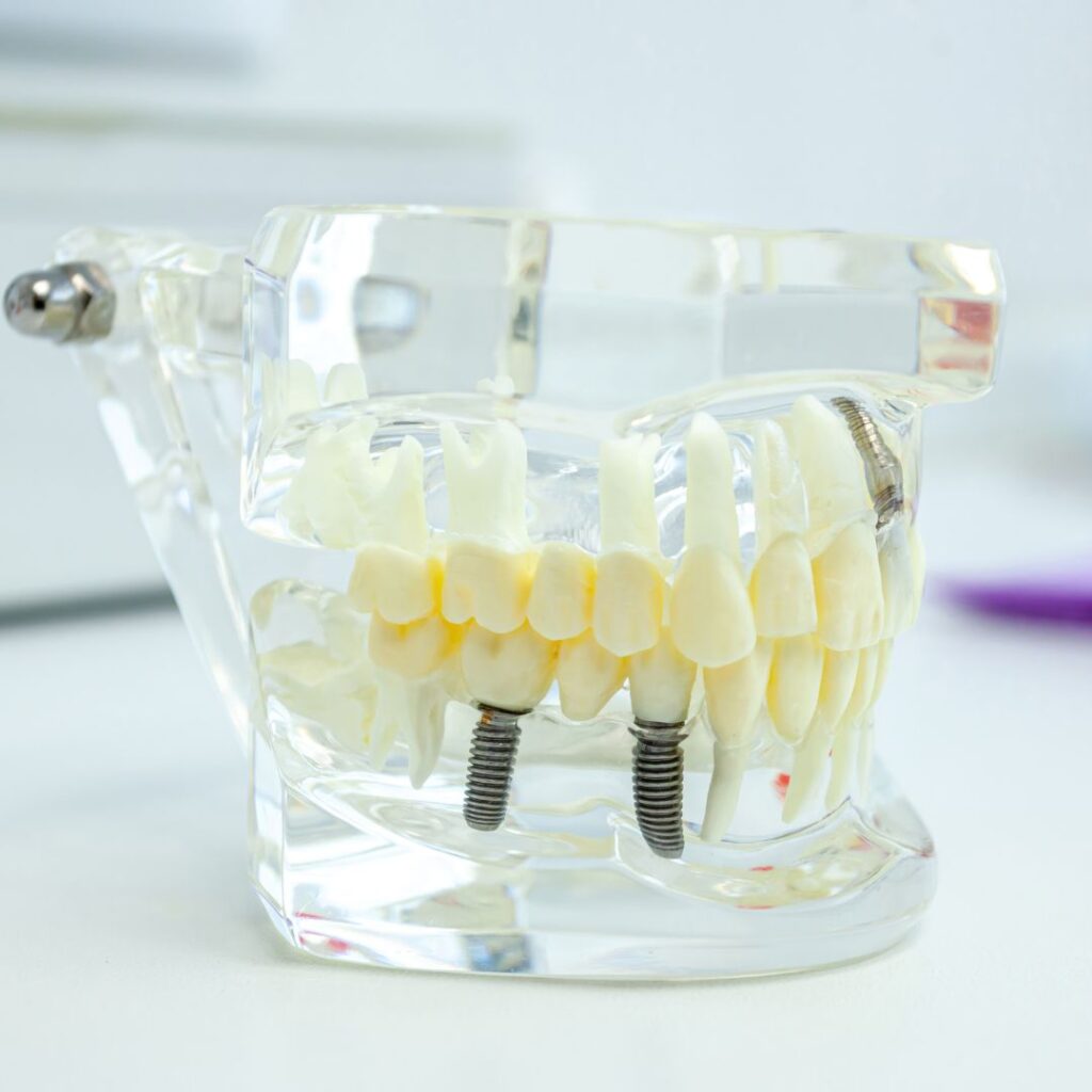 implante dental, un puente o una prótesis dental