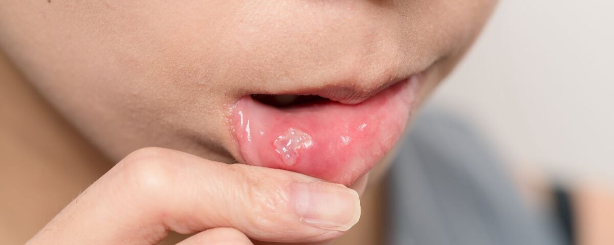 una llaga en la boca