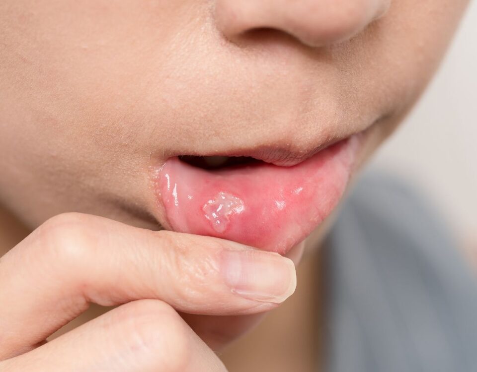 una llaga en la boca