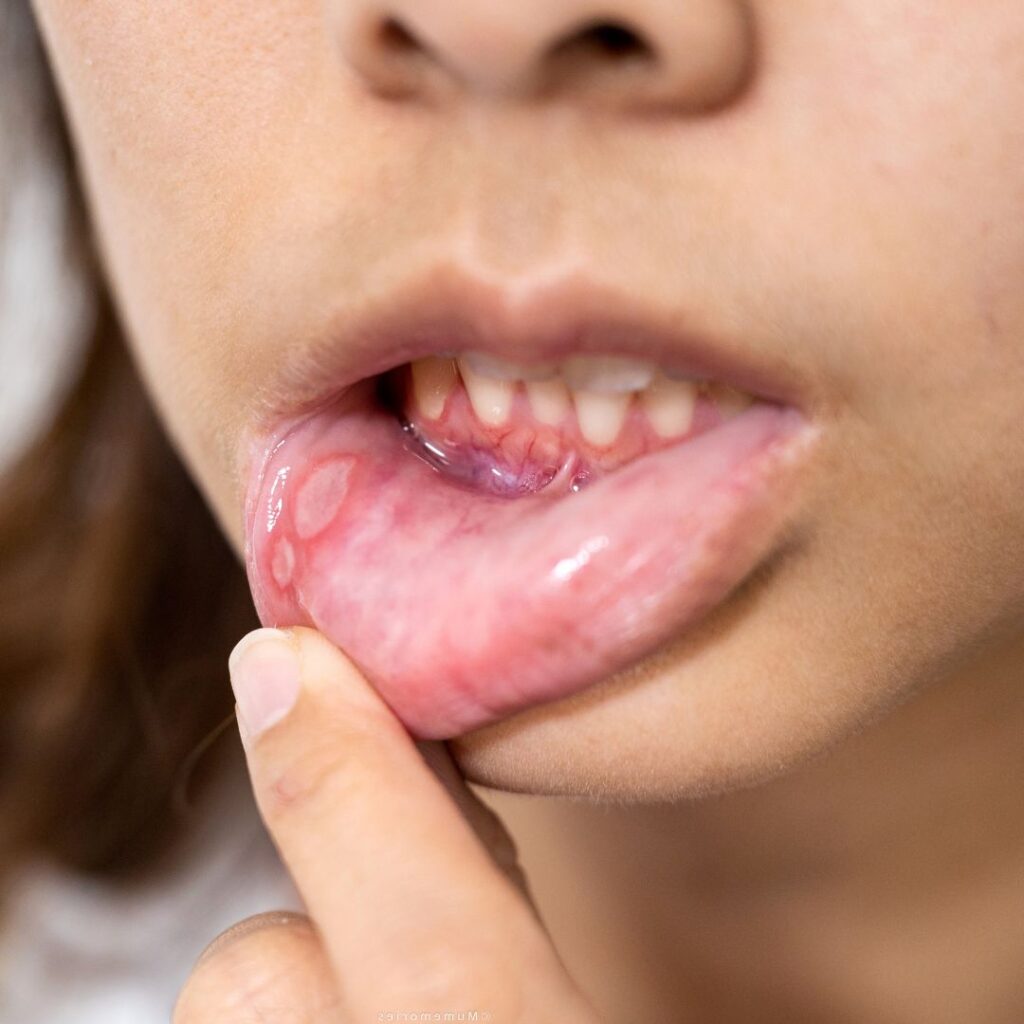 una llaga en la boca
